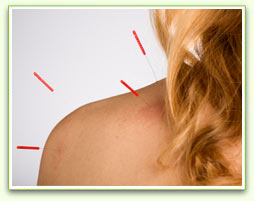 Acupuncture Treatment